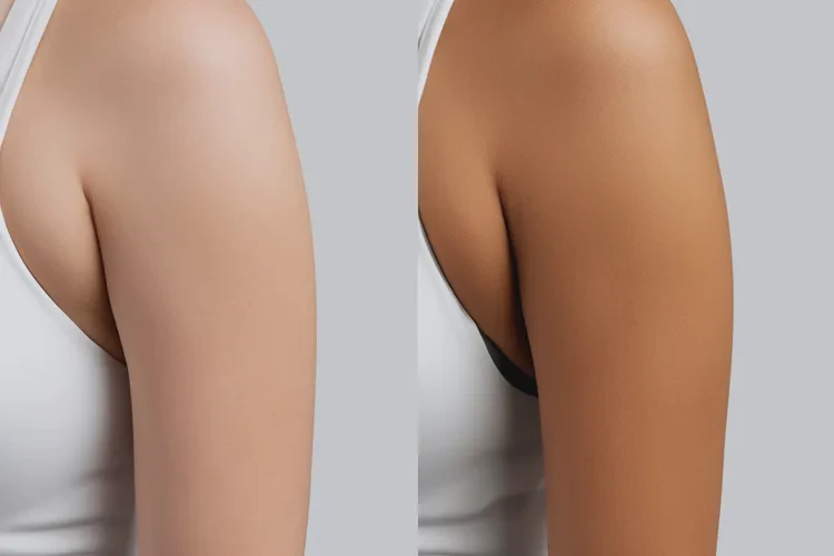 2025年广东江门冷冻减脂瘦手臂哪家做的好(图3)