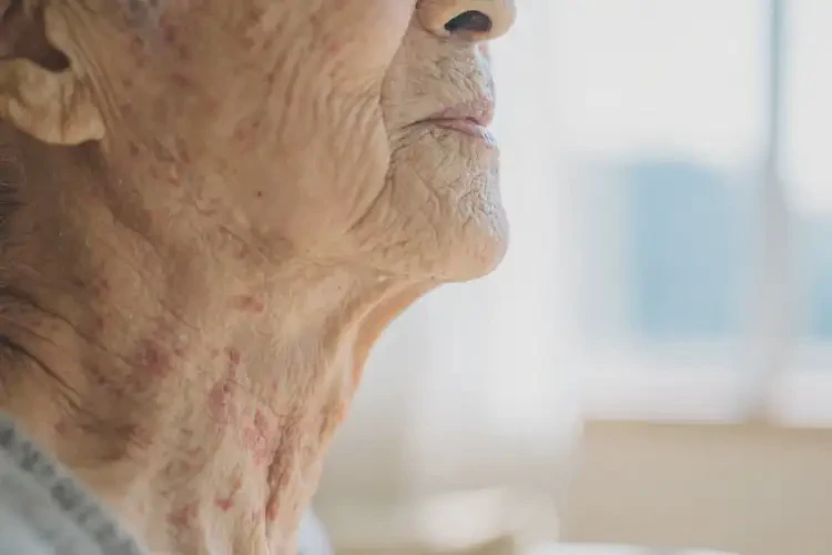 高龄老人脖子出湿疹可不可以自愈(图3)
