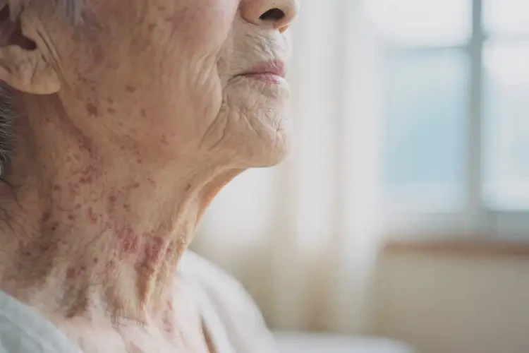 高龄老人脖子出湿疹可不可以自愈(图2)