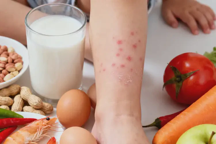 孩子小腿上偶爾長(zhǎng)濕疹哪些東西吃了會(huì)不好(圖4)