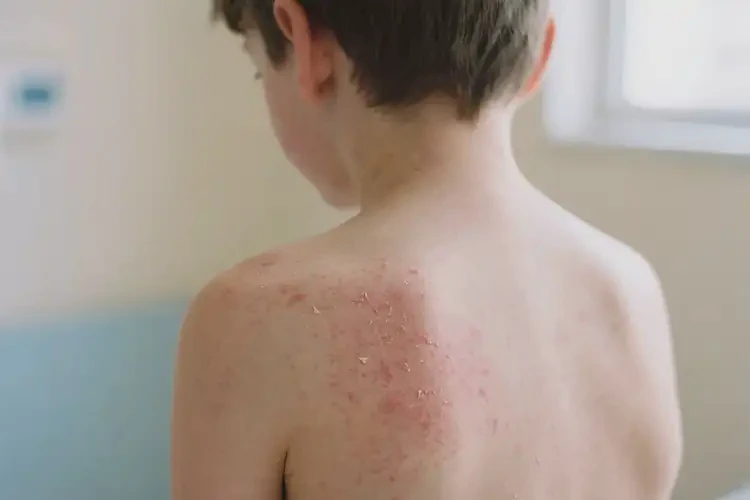青少年身上長濕疹可以自愈嗎(圖4)