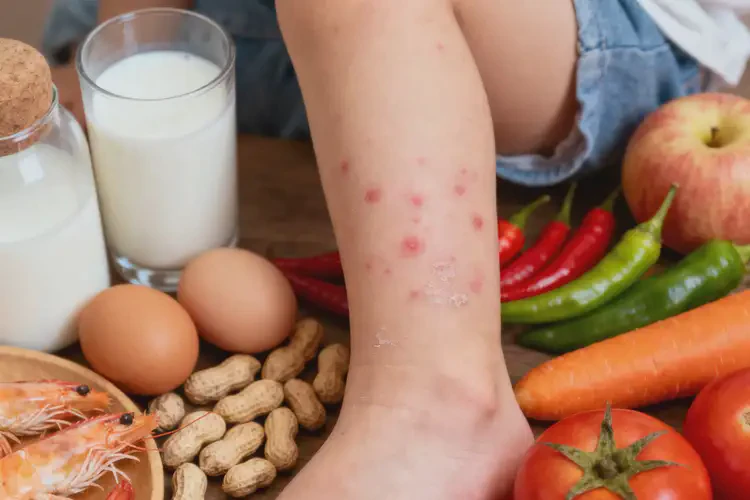 孩子小腿上偶爾長(zhǎng)濕疹哪些東西吃了會(huì)不好(圖3)