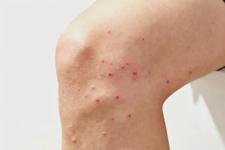 男生大腿上偶爾長(zhǎng)濕疹能靠自己自愈嗎(圖4)