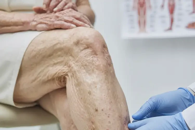 老年人小腿上的濕疹是怎么引起的(圖4)