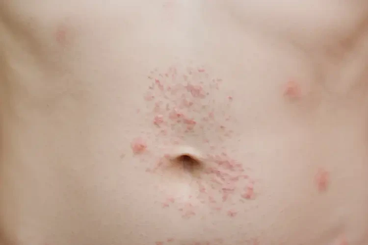 大學生肚子上出現濕疹會自己好嗎(圖4)