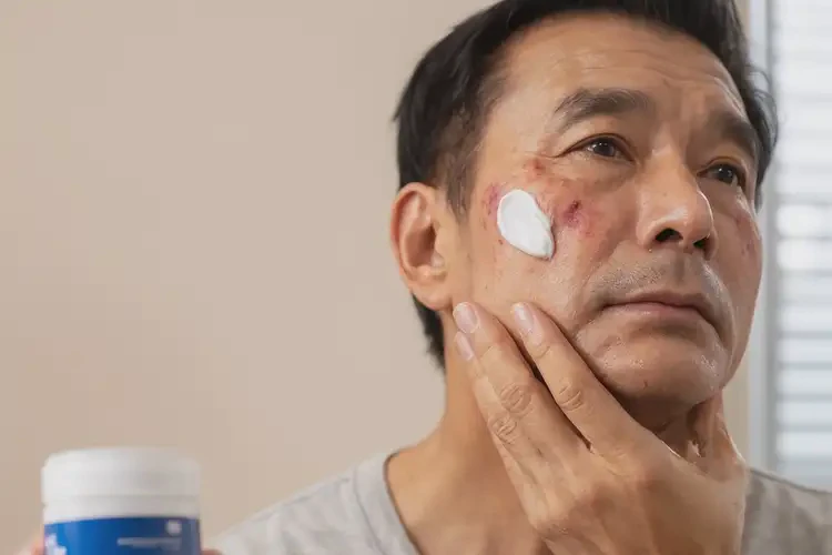 男性臉上容易長濕疹能不能徹底自愈(圖3)