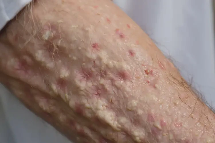 老年人全身出現(xiàn)濕疹能自愈嗎(圖4)