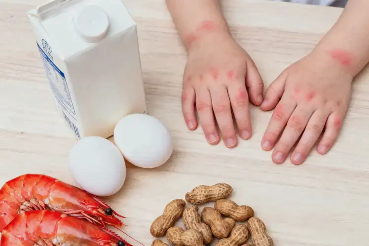 幼兒手上偶爾長濕疹哪些不太適合吃(圖1)