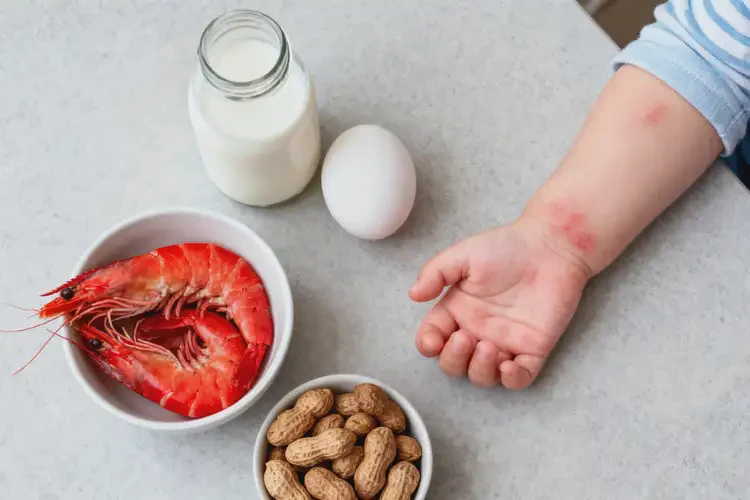 幼兒手上偶爾長濕疹哪些不太適合吃(圖2)