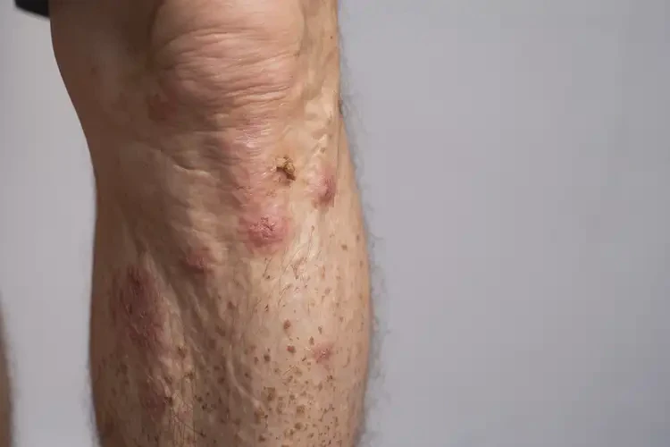 老年人小腿偶爾長濕疹什么東西最好不吃(圖4)