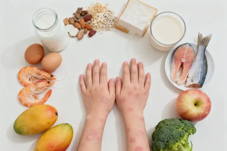 小兒手上經(jīng)常長濕疹哪些食物要避免(圖4)