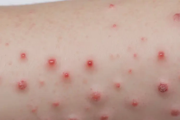 孩子屁股偶爾起濕疹能自愈嗎(圖4)