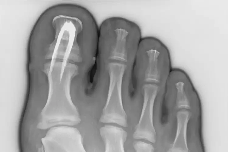 遼寧阜新康復(fù)科看足跟疼要多久(圖4)