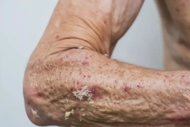 老年人全身有濕疹能自愈嗎(圖4)