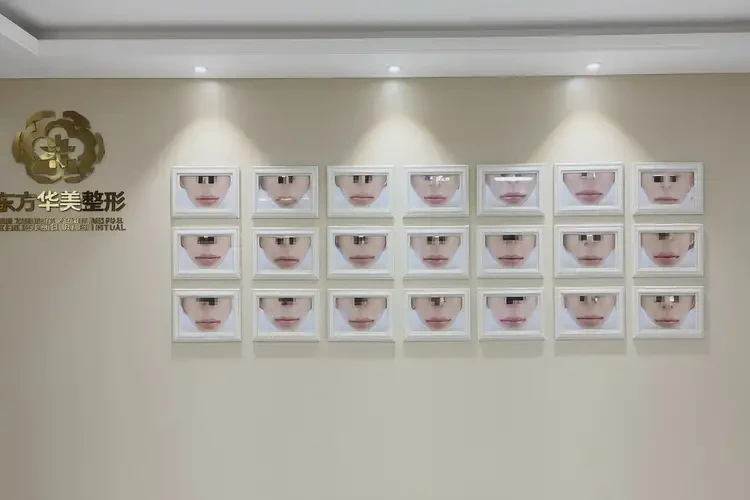 2025年海南東方自體軟骨墊鼻尖哪家做的好(圖2)