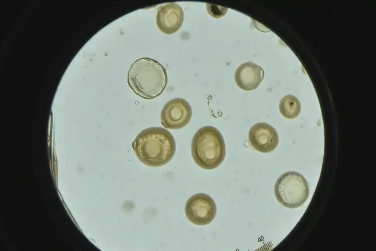 39歲女性感染阿米巴蟲多久后會出現(xiàn)發(fā)熱癥狀(圖3)