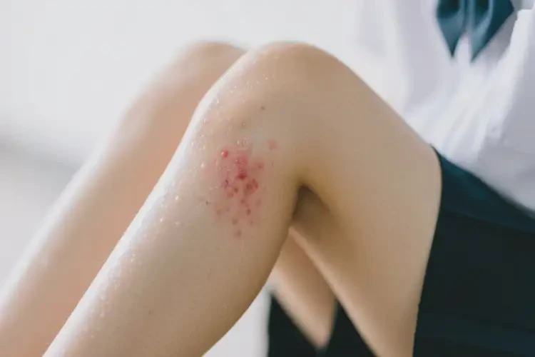 大學(xué)生小腿出現(xiàn)濕疹能自愈嗎(圖3)