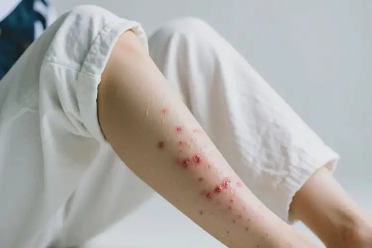 大學(xué)生小腿出現(xiàn)濕疹能自愈嗎(圖4)