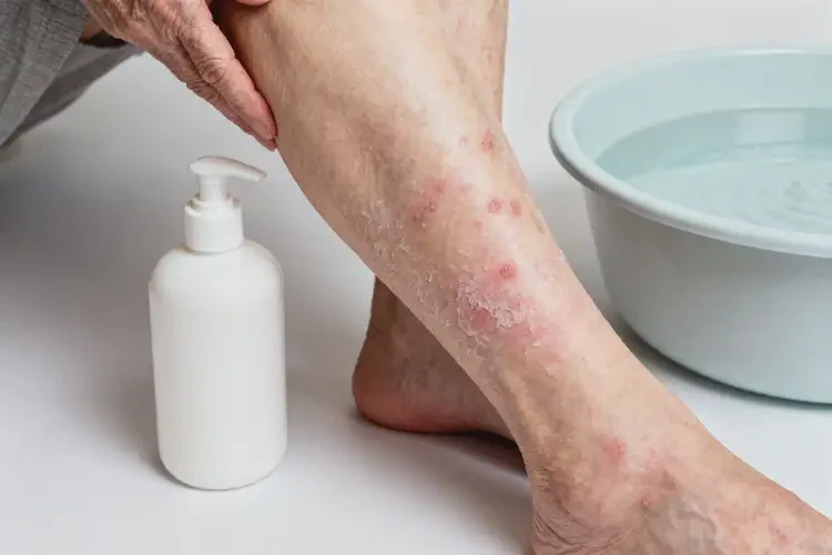 老年人身上經(jīng)常長(zhǎng)濕疹能不能自愈(圖3)