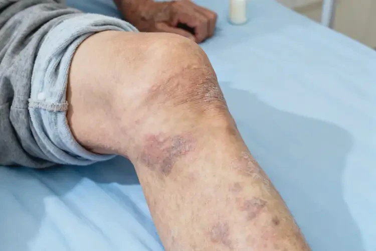 老年人大腿經(jīng)常長濕疹能不能自愈(圖3)