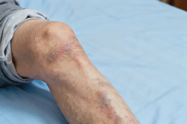 老年人大腿經(jīng)常長濕疹能不能自愈(圖2)