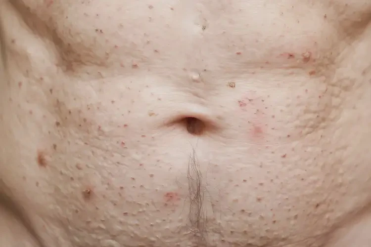 老年人肚子上容易長(zhǎng)濕疹能不能自愈(圖4)