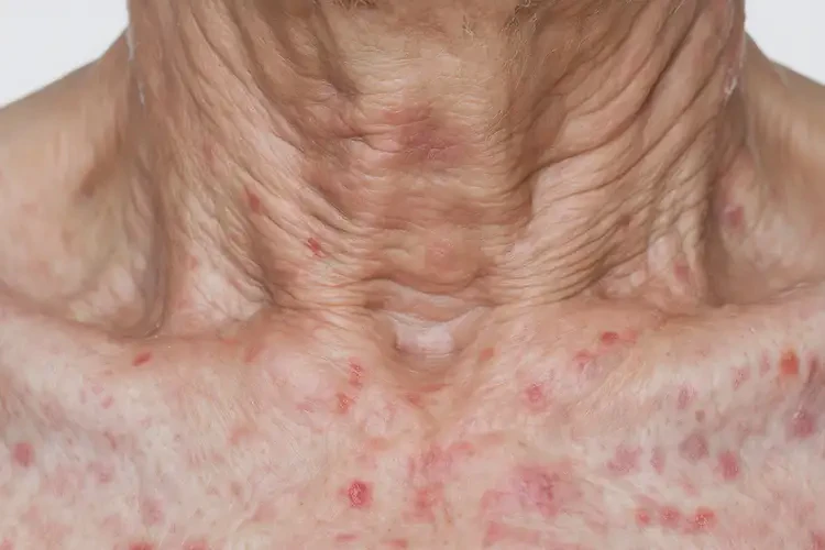 老年人脖子出現(xiàn)濕疹怎么算是痊愈(圖4)
