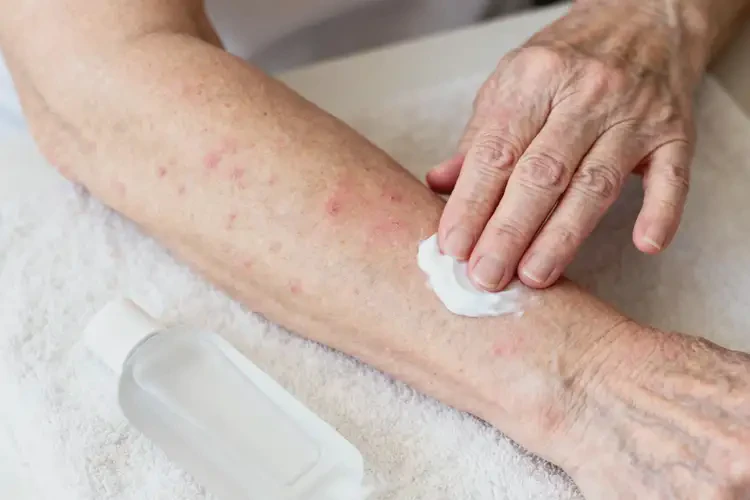 老年人手臂經(jīng)常長濕疹會自己好嗎(圖4)