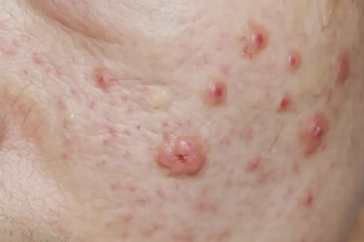 老年人脖子出現(xiàn)濕疹怎么算是痊愈(圖2)