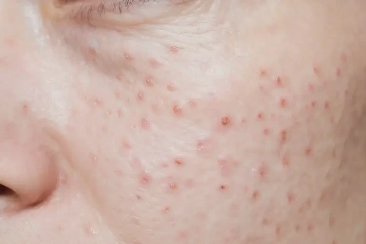 老年人脖子出現(xiàn)濕疹怎么算是痊愈(圖1)