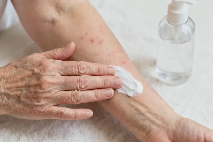 老年人手臂經(jīng)常長濕疹會自己好嗎(圖2)