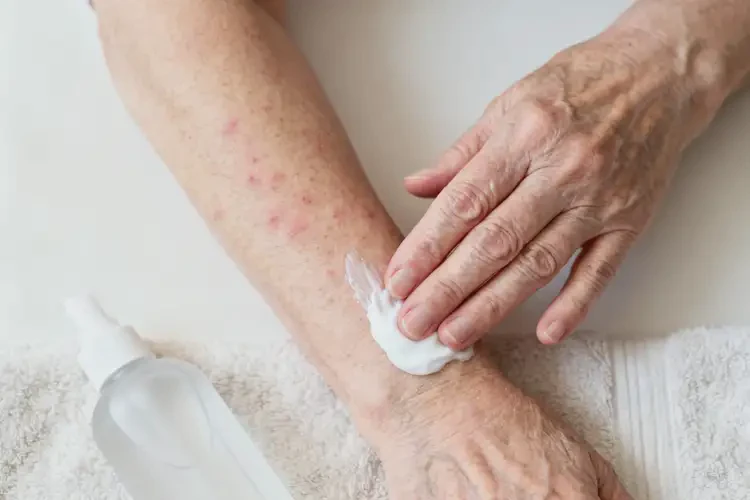 老年人手臂經(jīng)常長濕疹會自己好嗎(圖1)