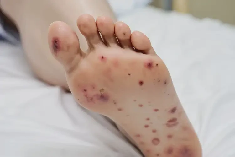 产妇脚上容易长湿疹会自己好吗(图3)