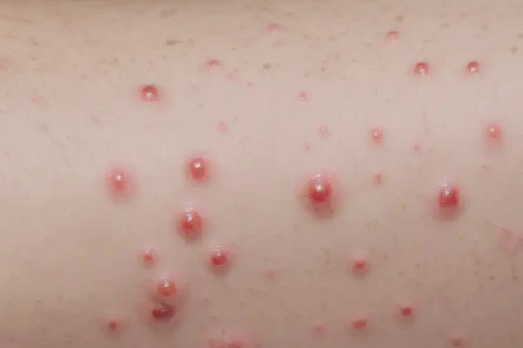 孩子小腿上偶尔起湿疹康复的全过程(图4)