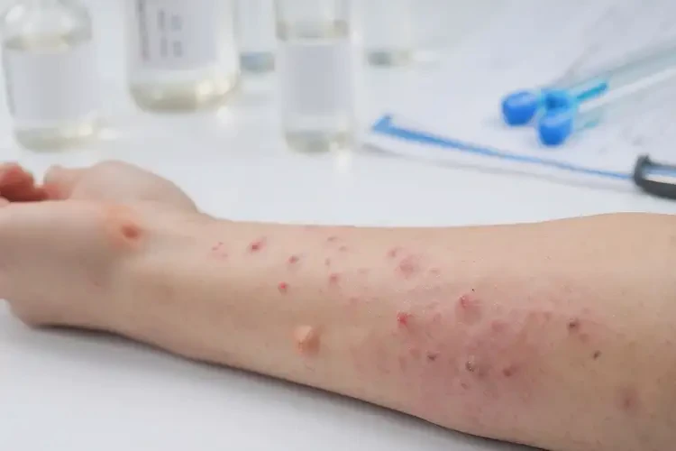 男性大腿上的湿疹是怎么引起的(图2)