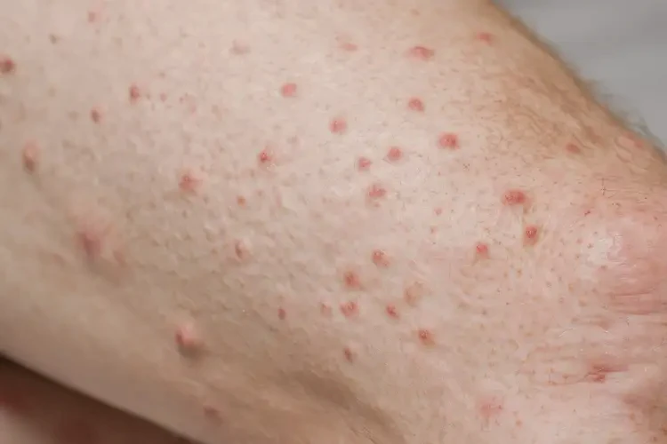 老年人大腿經(jīng)常起濕疹可不可以自愈(圖4)