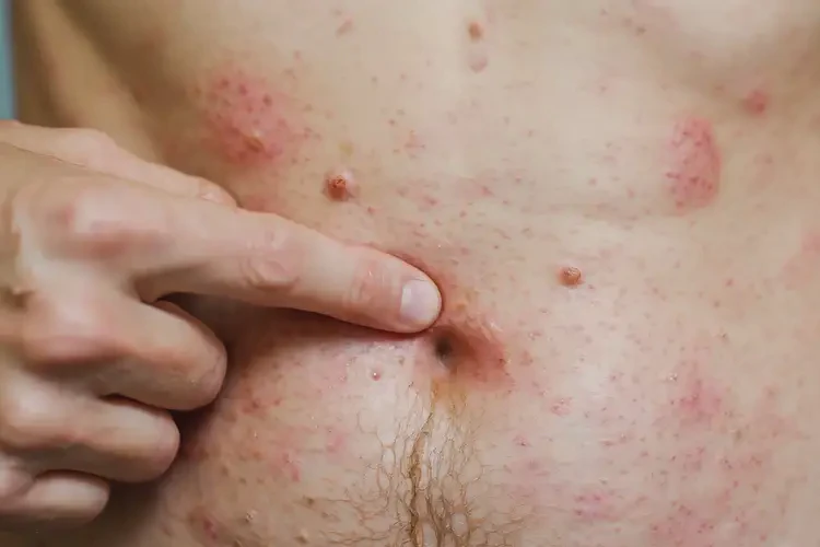 肚子上有濕疹有什么要忌口(圖4)