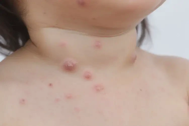 小孩脖子上长湿疹能自愈吗(图4)