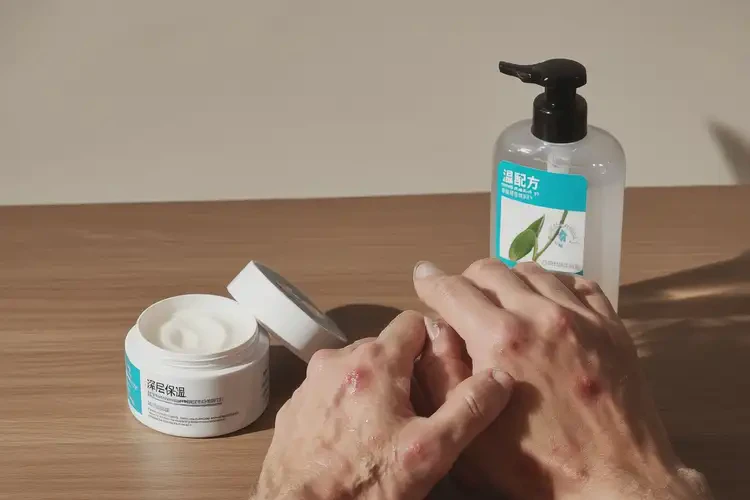 男人手上經(jīng)常長(zhǎng)濕疹最簡(jiǎn)單自愈方法(圖1)