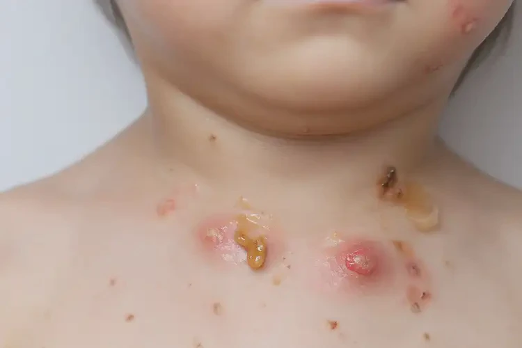 小孩脖子上长湿疹能自愈吗(图3)