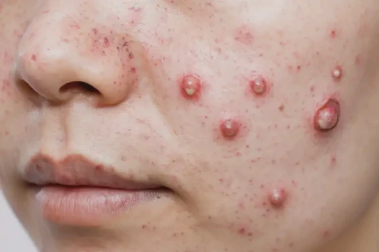 玫瑰痤瘡如何檢查(圖4)