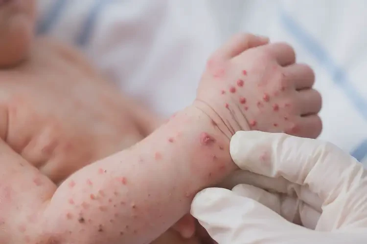 新生兒手臂出濕疹康復(fù)的全過程(圖4)