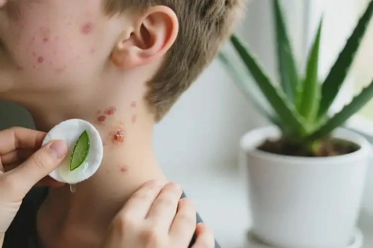 青少年脖子上容易長(zhǎng)濕疹治療方法(圖3)