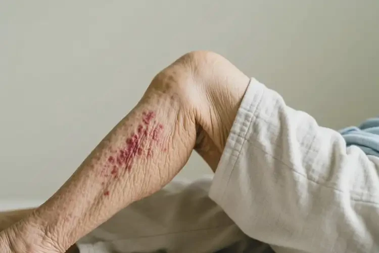 老年人大腿上容易起濕疹不管它會(huì)自己好嗎(圖1)