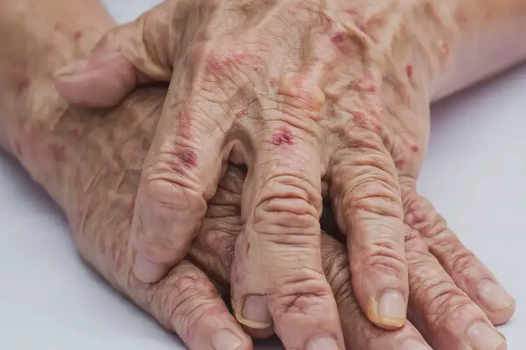 老年人手上出濕疹可不可以徹底自愈(圖4)
