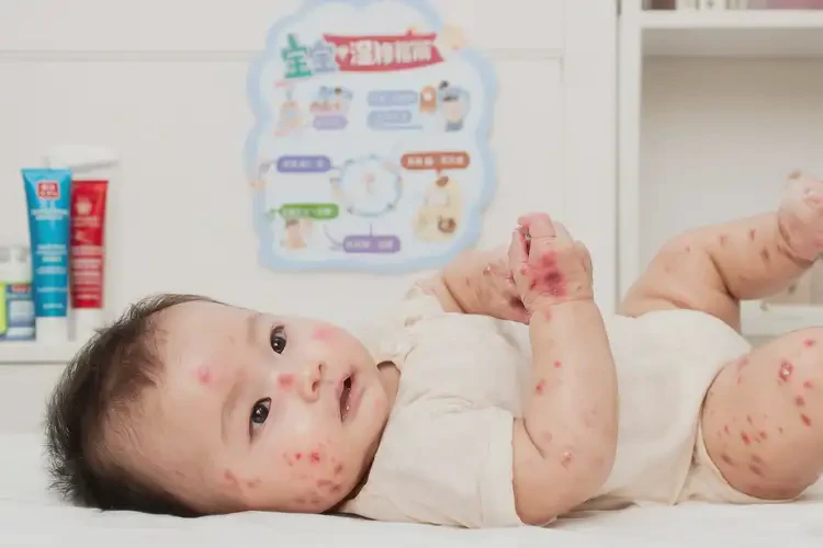 嬰幼兒四肢偶爾長(zhǎng)濕疹不管它會(huì)自己自愈嗎(圖4)