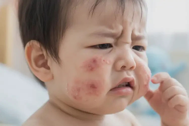 幼兒臉上經(jīng)常長濕疹可以徹底自愈嗎(圖4)