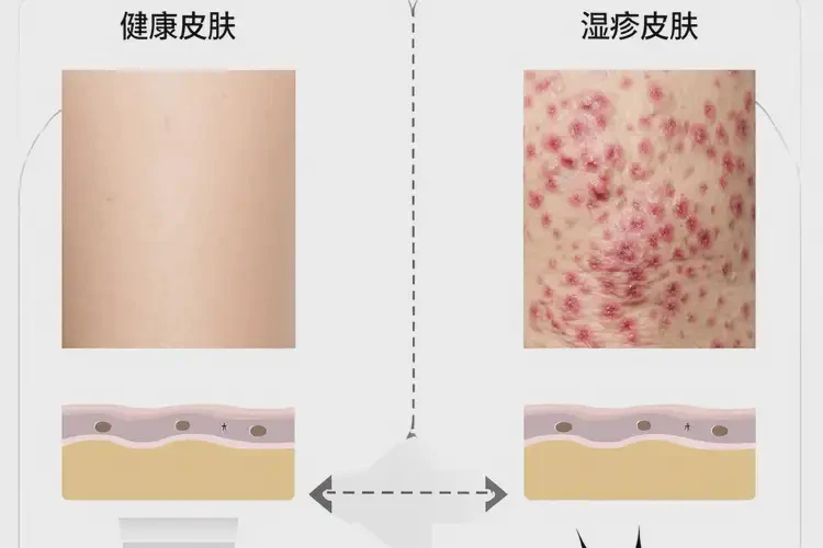 男人屁股起濕疹不管它會(huì)自己好嗎(圖2)