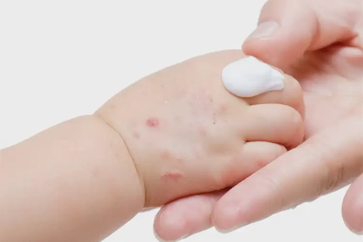 儿童手上长湿疹会自己好吗(图3)