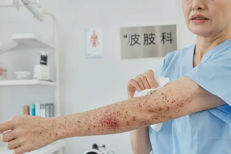 小孩腳上出濕疹可以徹底自愈嗎(圖1)